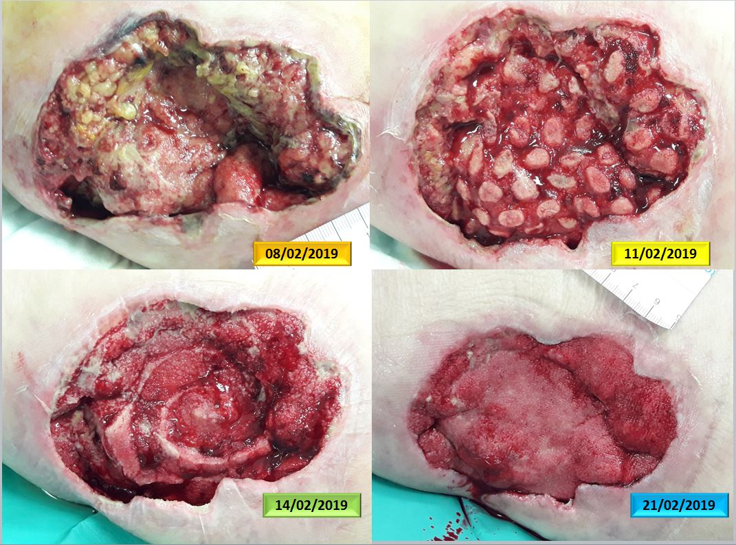 Figure 8. Evolution of the wound bed in 13 days.JPG