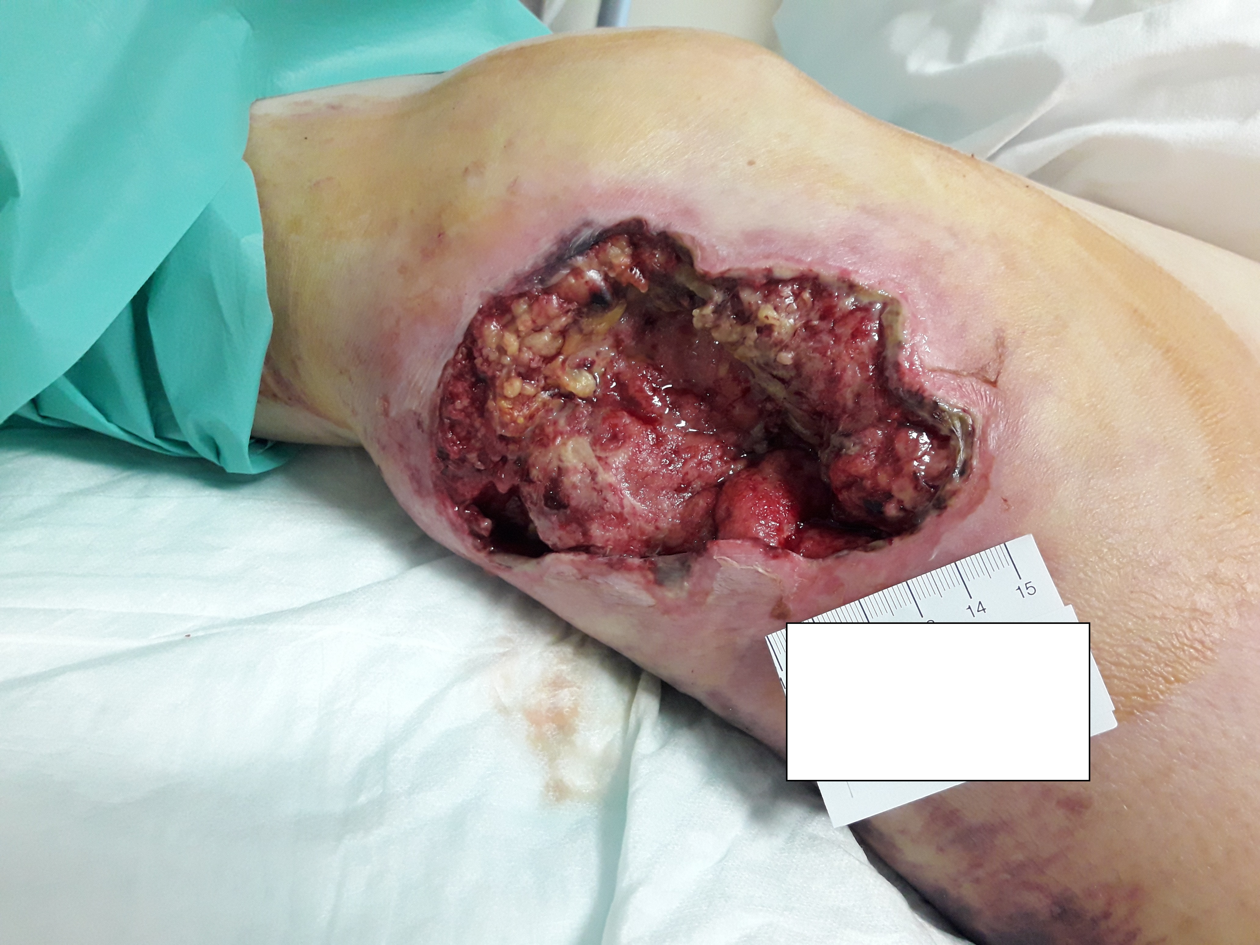 Figure 1: Wound bed at the first assessment (on February 8th 2019)