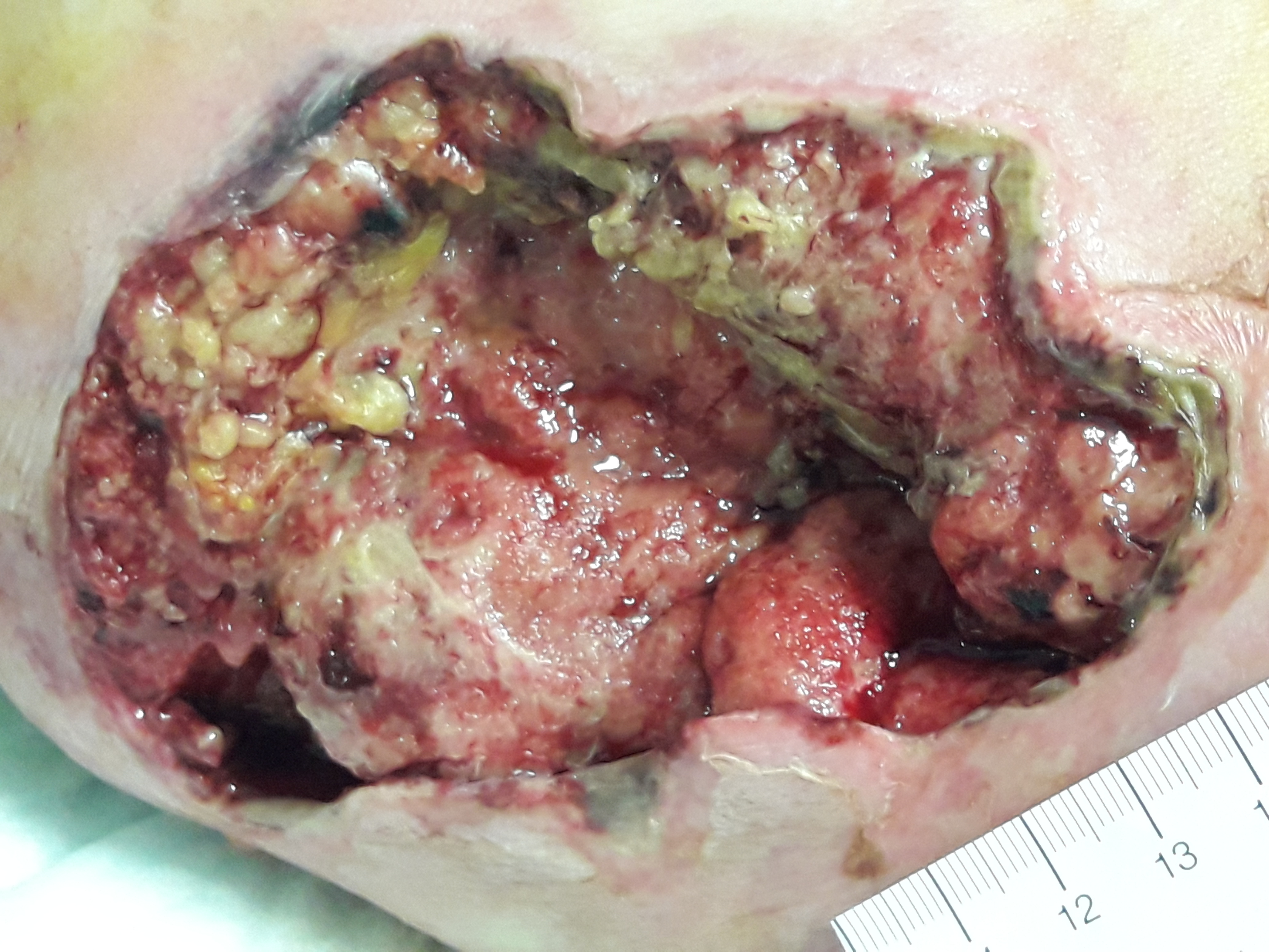 Figure 1a: Wound bed at the first assessment (on February 8th 2019) - image enlargement