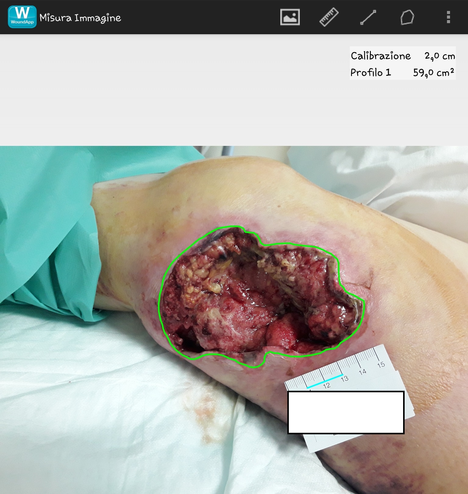 Figure 2: Measuring the wound bed at the first assessment (on February 8th 2019)