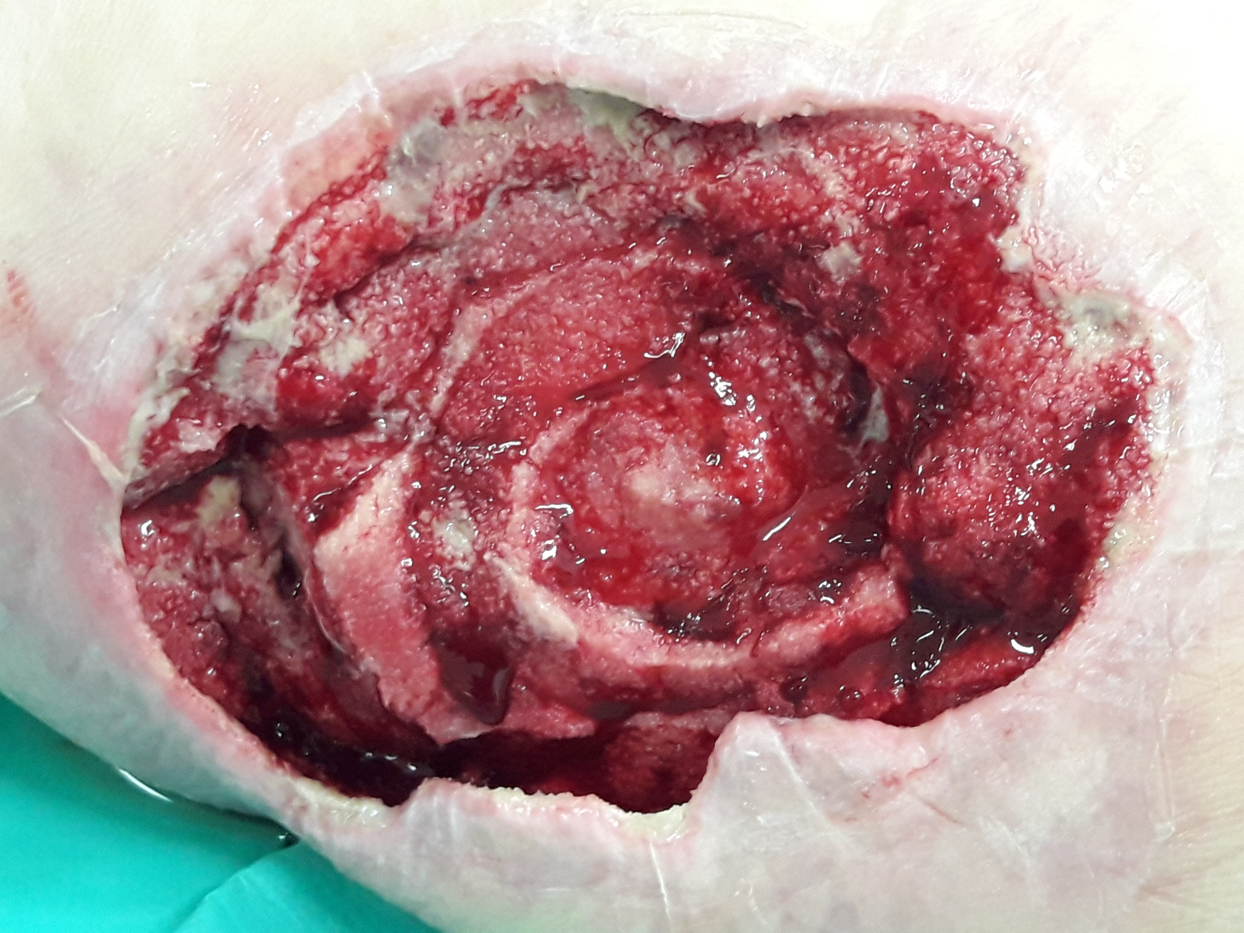 Figure 4a: appearance of the wound bed after 6 days of treatment (3 days with V.A.C. VERAFLO CLEANSE™) - image enlargement.