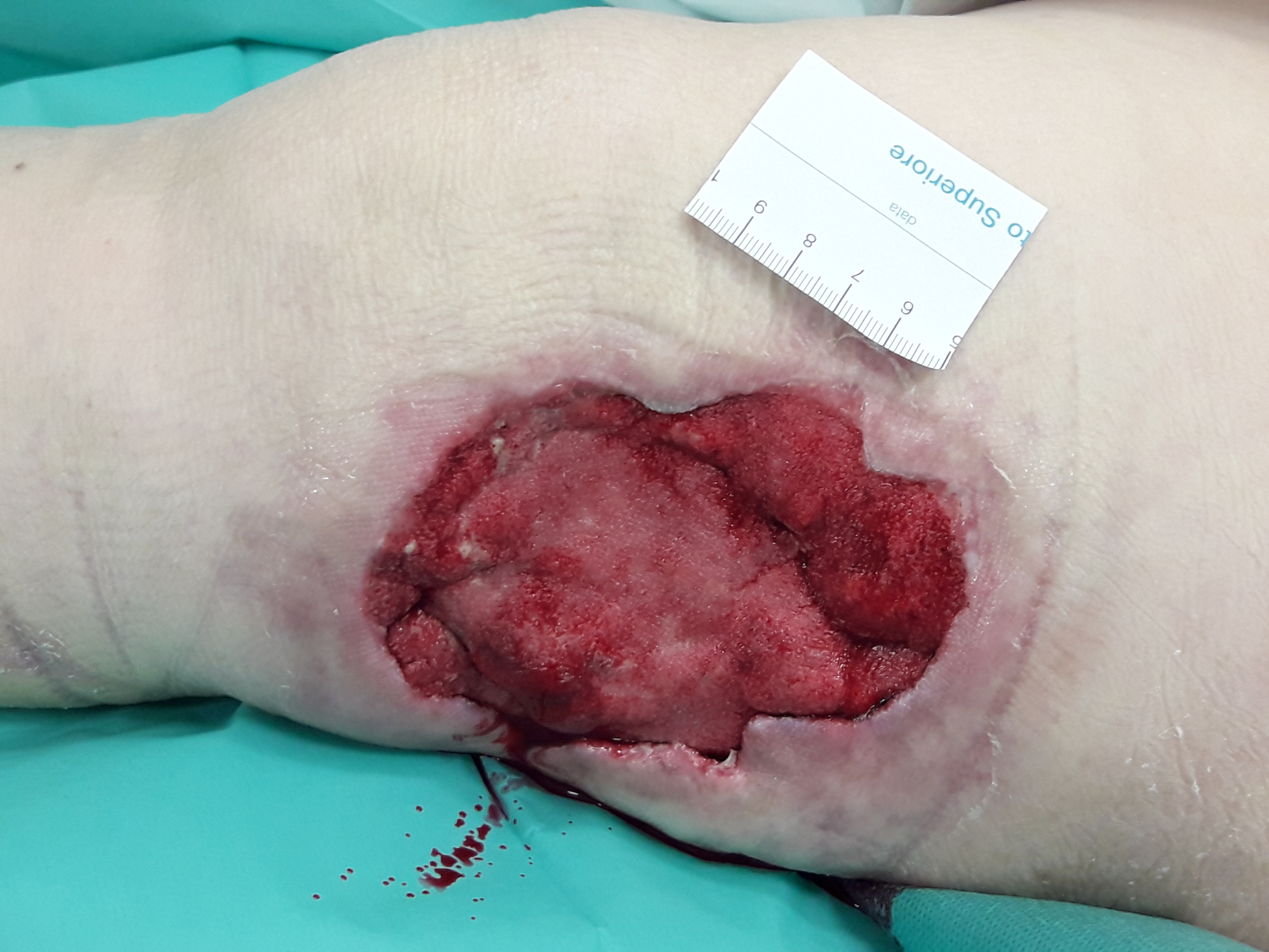 Figure 5: appearance of the wound bed after 13 days of treatment (7 days with V.A.C. VeraFlo™ Dressing, three dressing changes). 