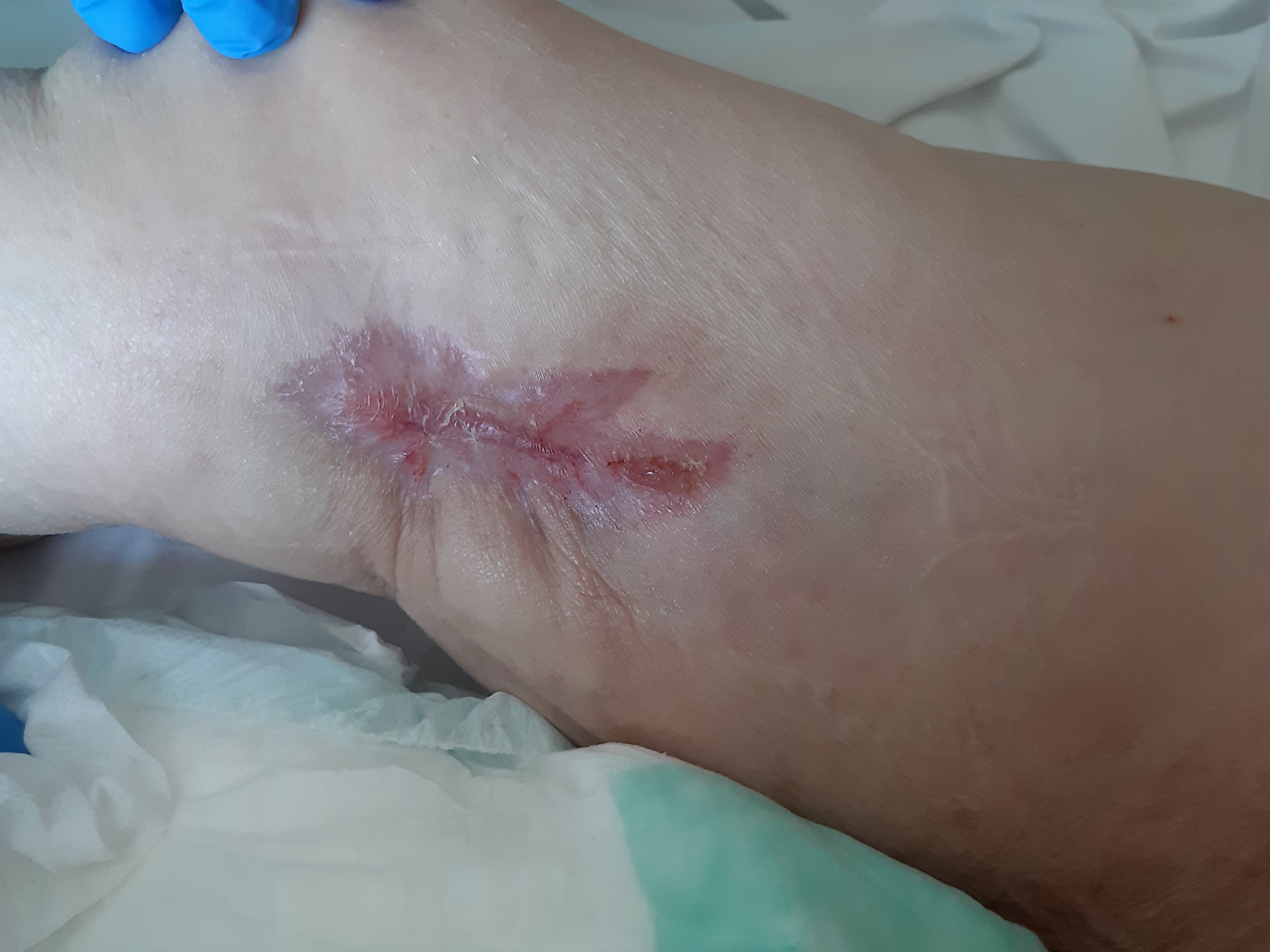 Figure 6 appearance of the wound bed on 16 May 2019