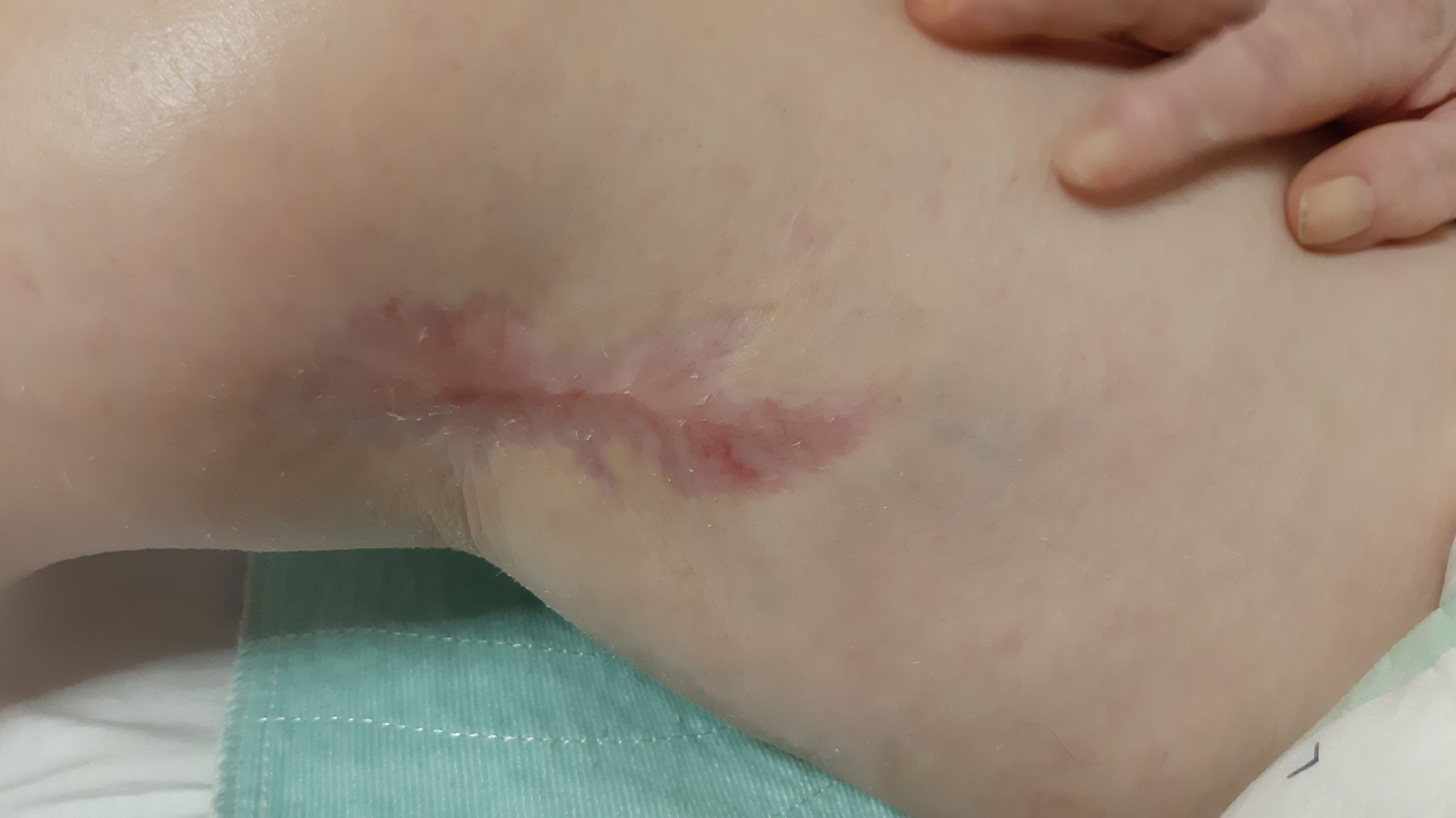 Figure 7 appearance of the wound bed on 26 November 2019